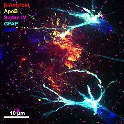 Is type 2 diabetes associated dementia a microvascular early-Alzheimer’s phenotype induced by aberrations in the peripheral metabolism of lipoprotein-amyloid?